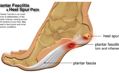 Adressing injuries – Plantar fasciitis