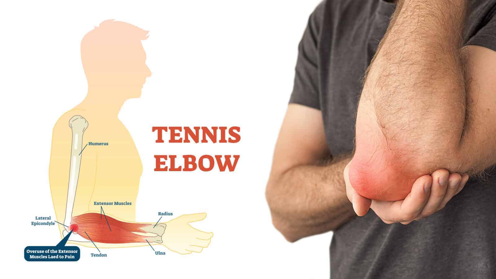 tennis-elbow-the-causes-the-treatment-total-body-fitness-4-u